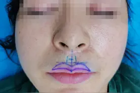 小姐姐挑战人中缩短与M唇，手术很吓人，效果很惊艳！图片