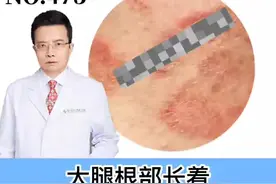 裆部大腿瘙痒长红斑内侧痒到睡不着，让你尴尬又不得不去挠痒不已，该怎么办？#股癣 #科普 #健康