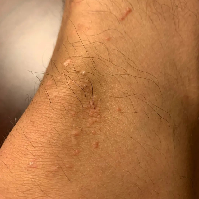 角化棘皮瘤的病理要点