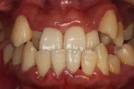 血癌的早期症状是什么样图片