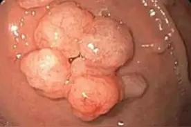 胃中长了息肉，医生却说，胃癌风险低图片