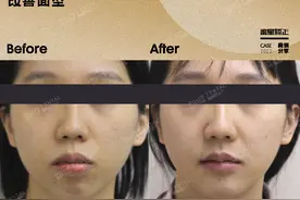 9颗骨钉高难度正畸骨性龅牙，矫正后夺回属于我的下巴！图片
