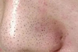 简单去除黑头的方法图片