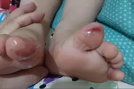 得了这病，孩子就像脱了一层皮的感觉，出过水泡的地方全部掉皮图片