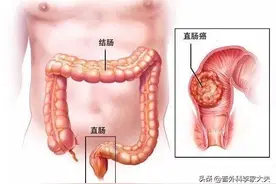 这位直肠癌患者，如果是我家人的话，就劝他别保肛了？图片