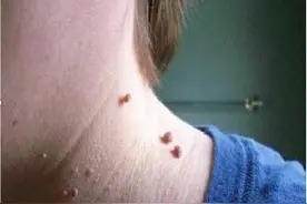 脸上、手臂、手背上好多“扁平疣”，中医一方法，解决皮肤问题图片