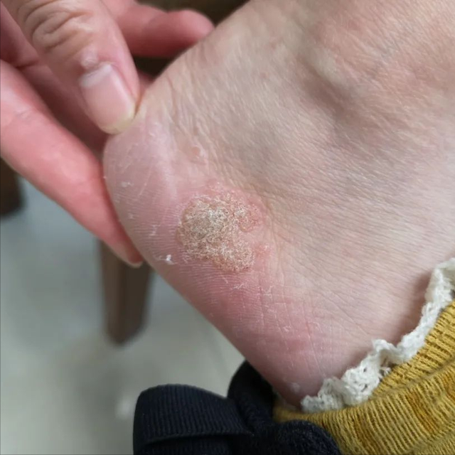 角化棘皮瘤的病理要点