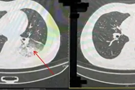 成都一男子吹空调致“白肺”，专家提醒警惕军团菌肺炎图片