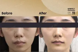 骨性龅牙，牙齿又“挤又“缺”还咬合错位，再糟糕也能做矫正！图片