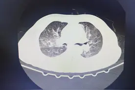 醉酒容易引起肺炎，如何避免，要采取恰当的睡姿。图片