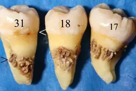 为什么牙齿总是长牙结石？洗牙都不管用的吗？图片