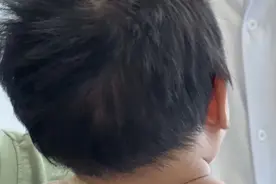 宝宝“歪头卖萌”？当心是小儿斜颈！图片