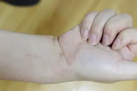 湿疹是怎样形成的？它的发病机制是怎样的？这3个常识你知道吗？图片