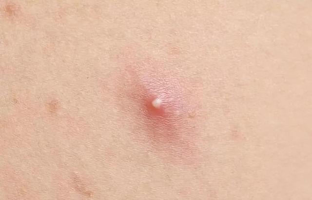 腹股沟皮肤像鸡皮疙瘩一样的东西