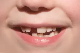 孩子过早拔了乳牙，新牙一直长不出来，咋办？图片
