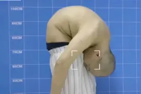 “折叠人”李华：骨头敲断4次、植入22颗钢钉，28年后重新学走路图片