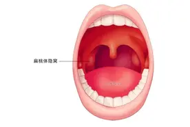 小儿扁桃体炎！小儿嗓子红、痛、化脓进来看...图片