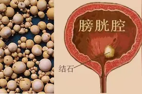 “圆溜的结石”——膀胱结石图片