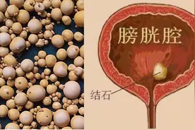 “圆溜的结石”——膀胱结石图片