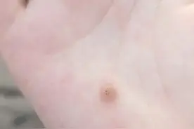 手上起了个刺猴图片