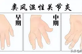手指疼痛？可能是这三种疾病在发信号图片