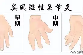 手指疼痛？可能是这三种疾病在发信号图片