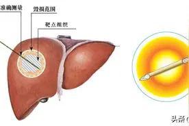 中年男性，体检发现小肝癌，穿刺一根针加热灭活肿瘤图片