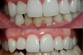 2023年牙粉真实测评：牙缝坚硬发黄牙石轻松清除，医学生亲测好用图片