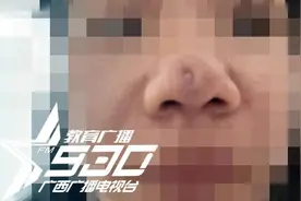 花数万元在南宁一机构隆鼻，鼻尖却出现凹坑！女子哭诉：我今年还要结婚图片