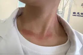 对自己的汗水过敏是多么痛苦图片