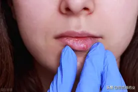 嘴唇经常起泡，都是这种“病毒”在作怪！医生：要治疗也要预防图片