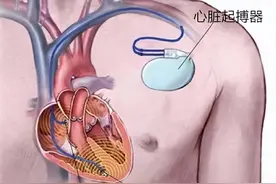 心脏病就要安装起搏器？安装完就一劳永逸？医生辟谣图片