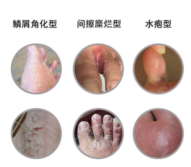 角化型脚气很痒怎么办