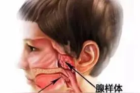 什么是腺样体？腺样体肥大有什么危害？图片