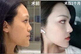 “医生，不做鼻基底填充也可以改善面中凹陷吗？”图片