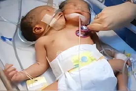 四川孕妇生下中国首例"双头女婴"，将产检医院告上公堂：赔我50万图片