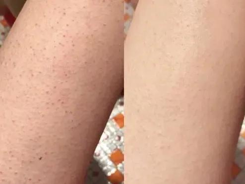 粗糙鸡皮肤女孩变得精致光滑