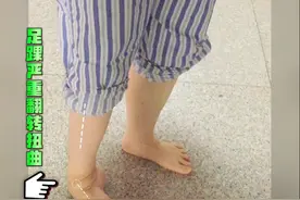 成年人重度僵硬性马蹄内翻足无创矫正自然复位图片