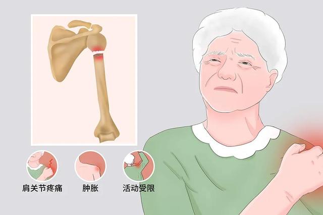 肱骨大结节骨折（肱骨近端骨折系列之合并大结节撕脱性骨折治疗）