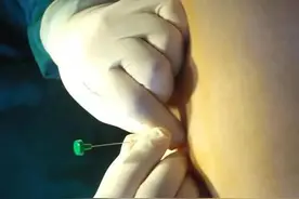 穴位埋线：一次相当针灸一周图片