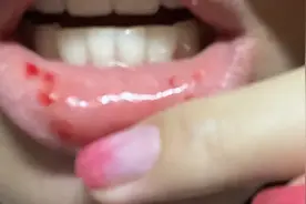 吃了半个菠萝，女孩嘴巴肿胀出血30分钟图片