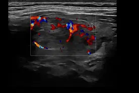解读甲状腺超声检查报告：3类结节到底危不危险图片