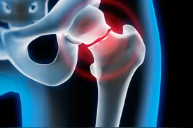 右股骨颈骨折 | 入院记录图片