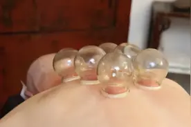 拔火罐吸出来的瘀血，是体内的毒素吗？告诉你真相，看完涨知识了图片
