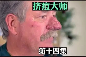 马里奥般的“酒糟鼻”，这居然都能治好图片