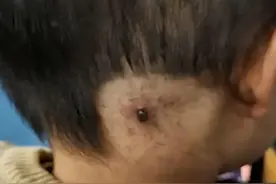 出门警惕这种虫，专挑孩子下手，养宠物更要注意了图片