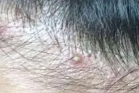 为什么头皮总长“疙瘩”和“脓包”？或与4个问题有关图片