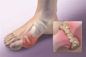 一文了解：5招缓解痛风的方法图片