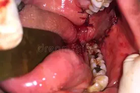 口腔癌做手术的话，能活多久呢？医生：从手术后的预后情况判断图片