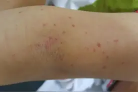 身上总是莫名其妙出现淤青？别大意，很有可能是患上过敏性紫癜了图片